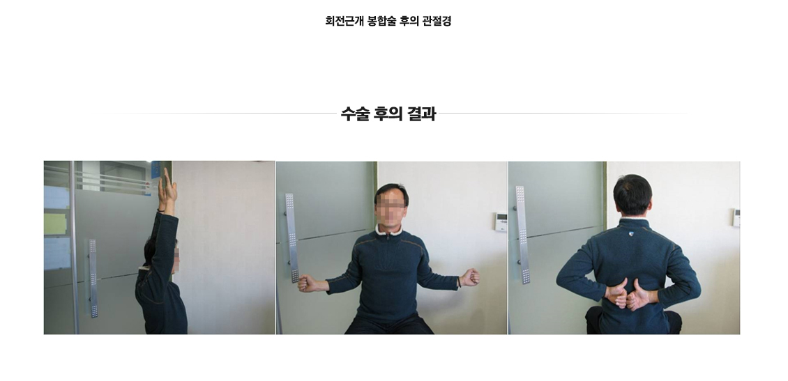 회전근개파열