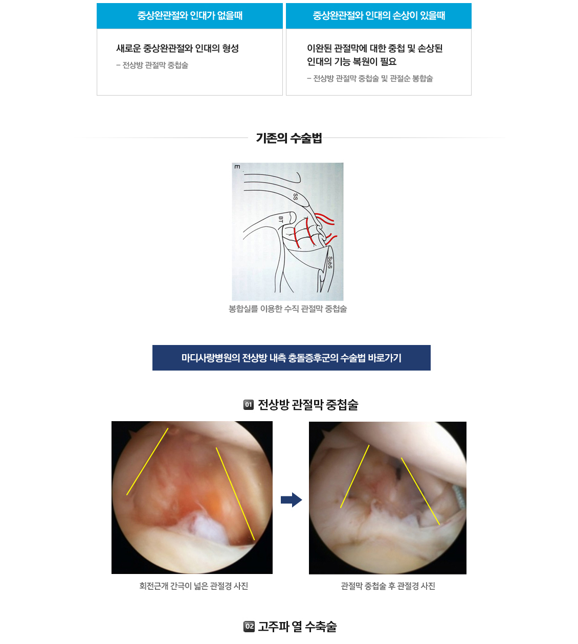 전상방내측충돌증후군