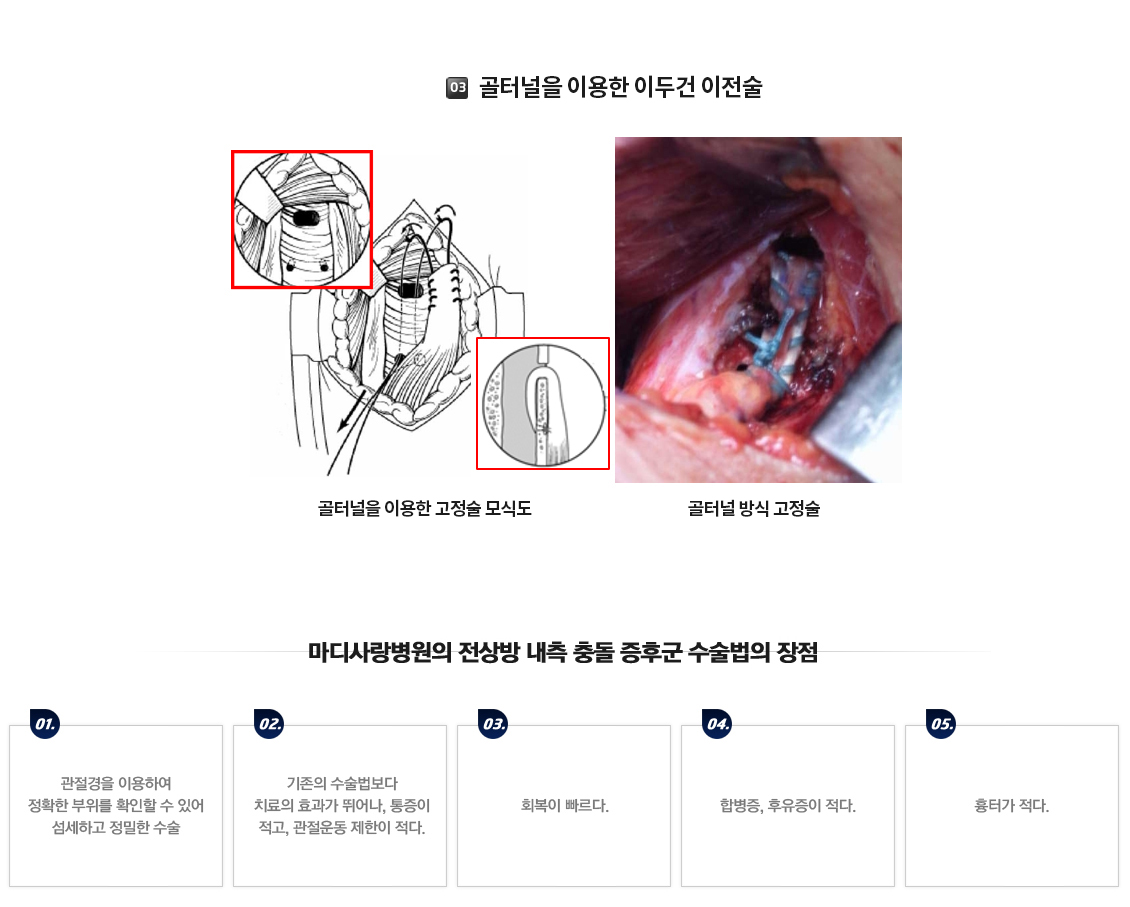 전상방내측충돌증후군