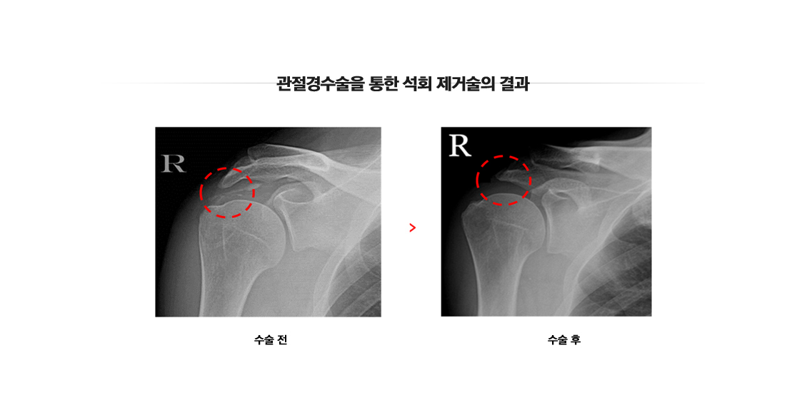 석회성건염