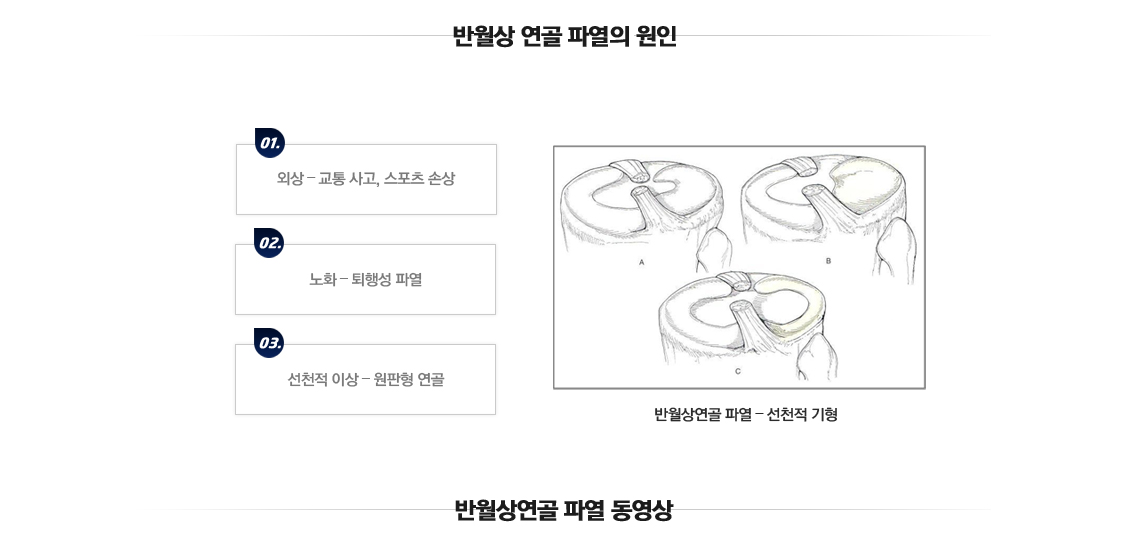 반월상연골파열