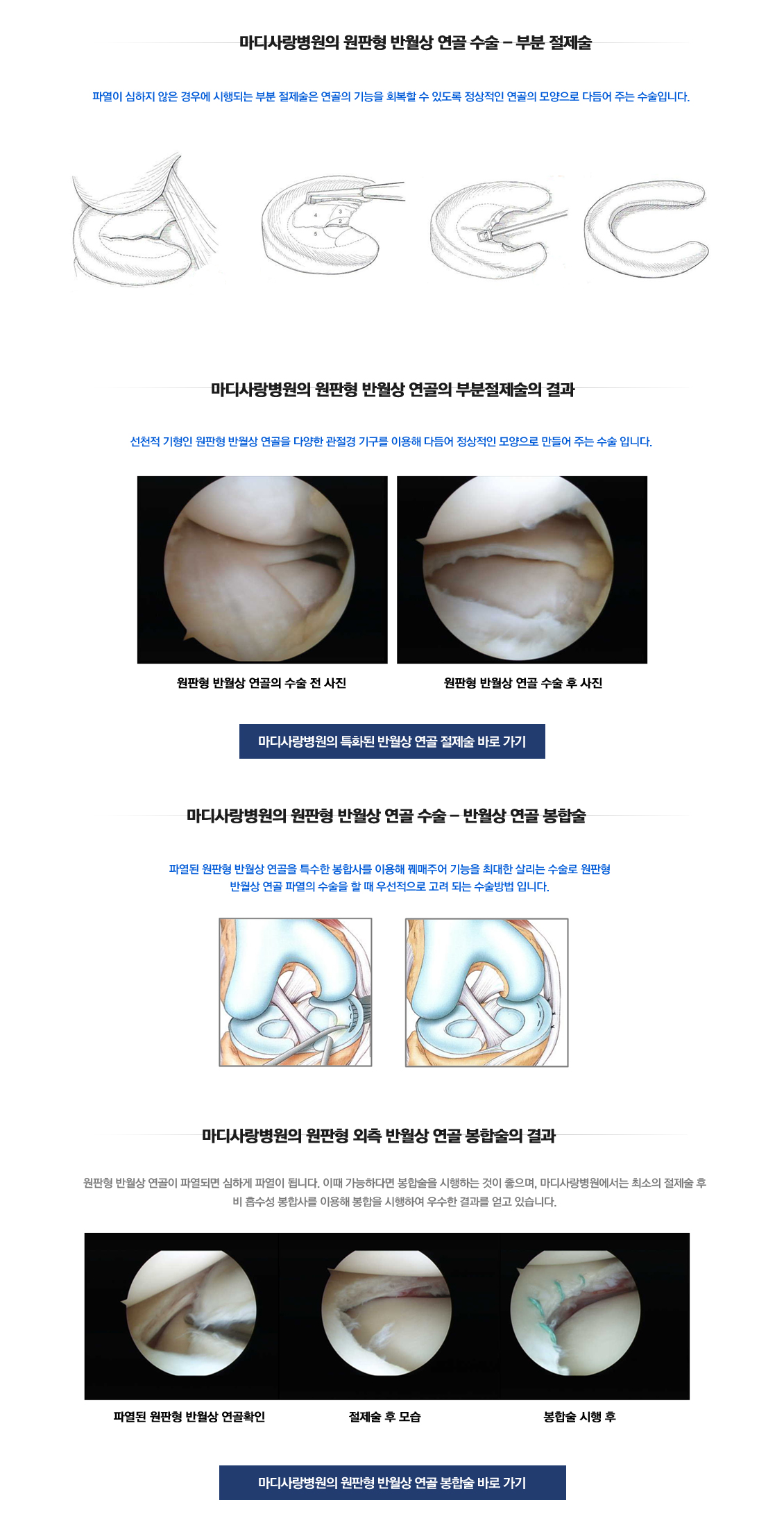 원판형 반월상 연골 파열