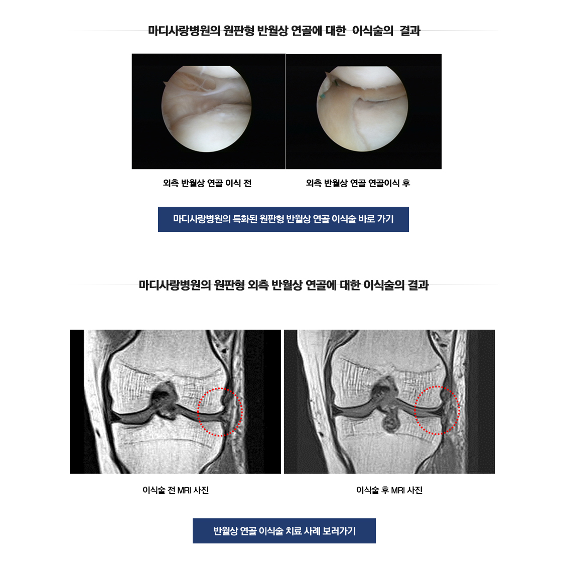 원판형 반월상 연골 파열