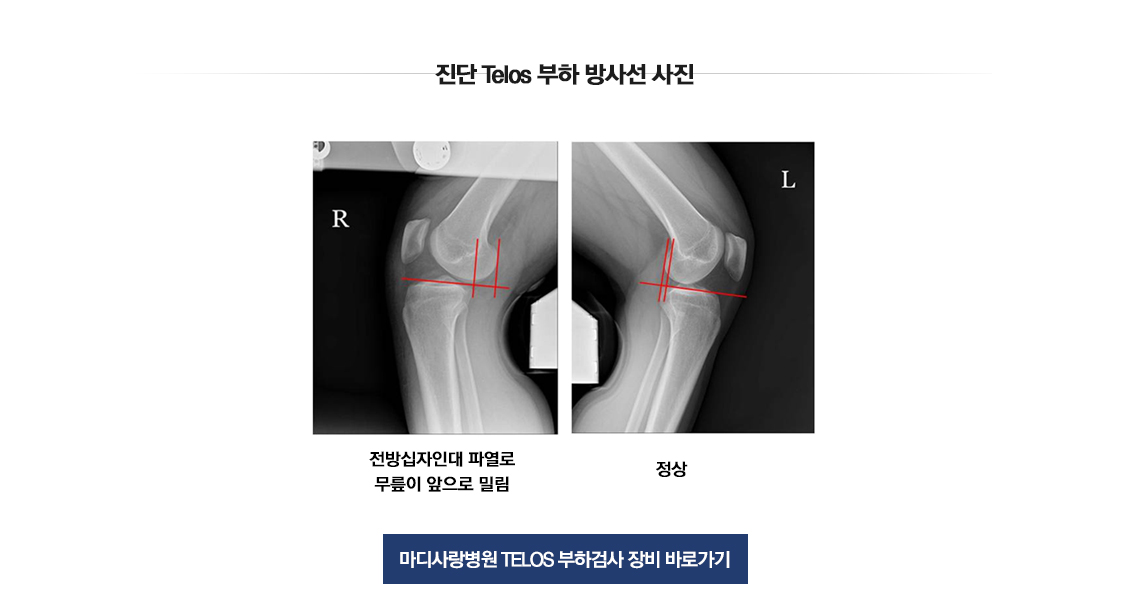 전방십자인대 파열