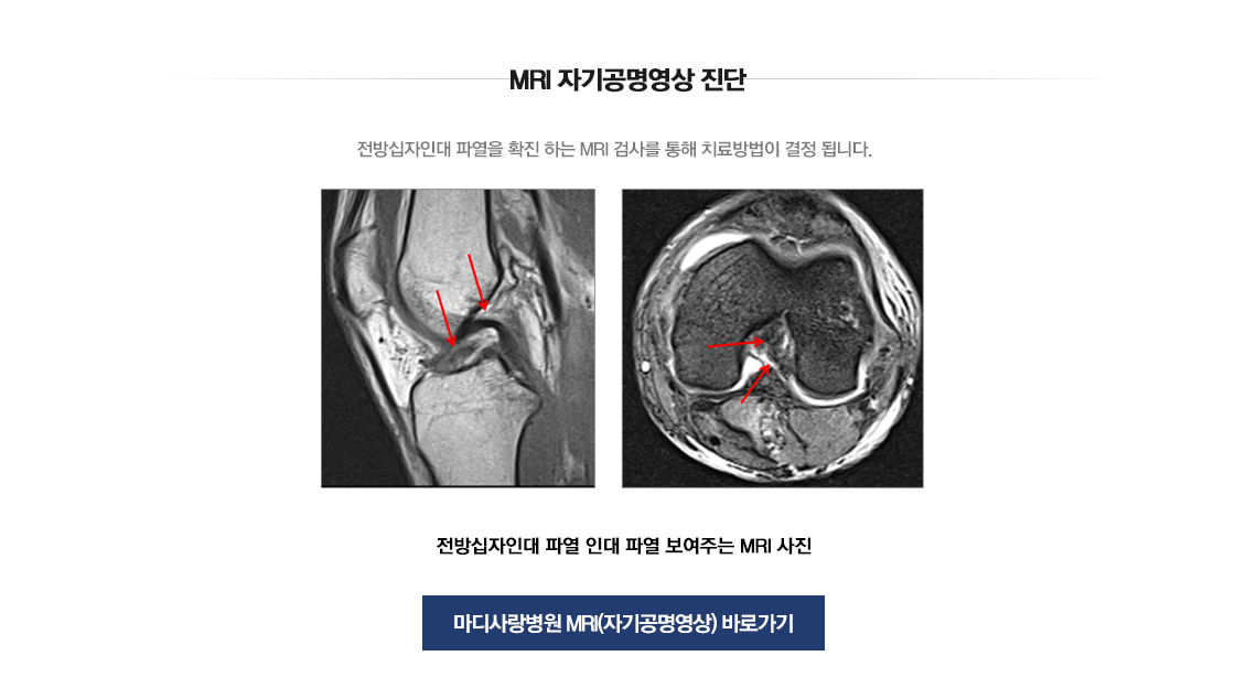 전방십자인대 파열