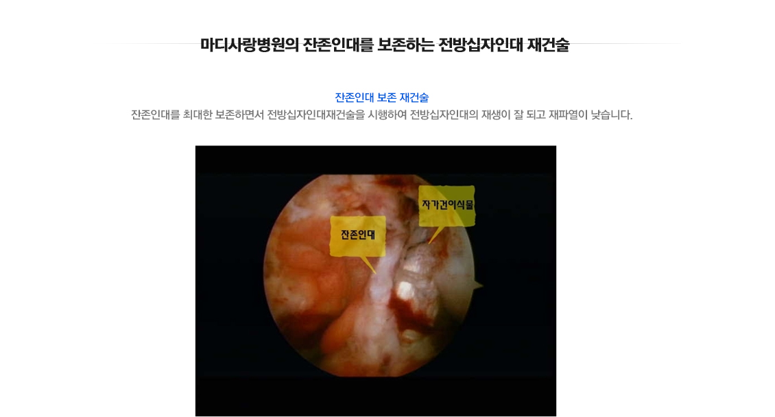 전방십자인대 파열