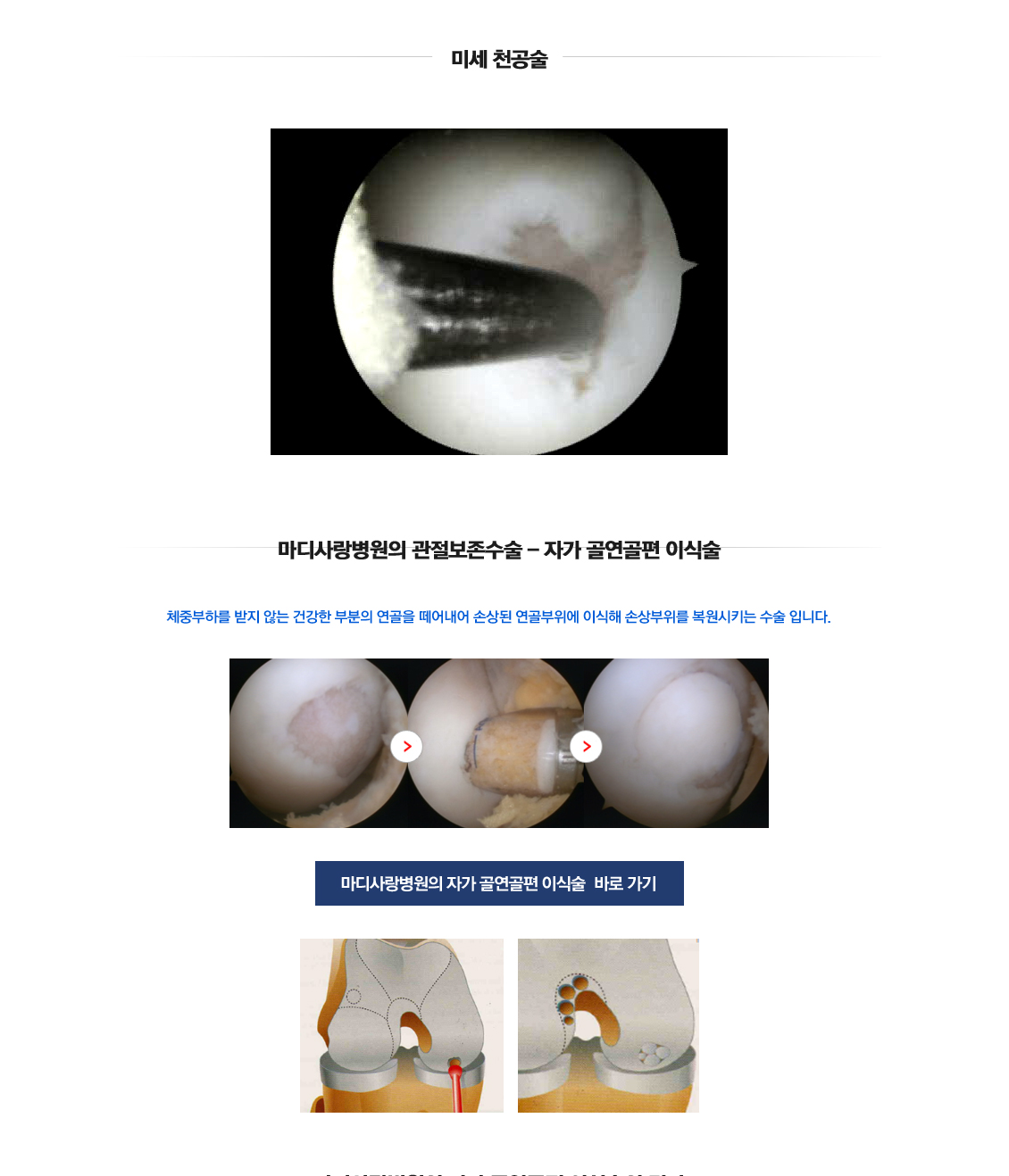 퇴행성관절염