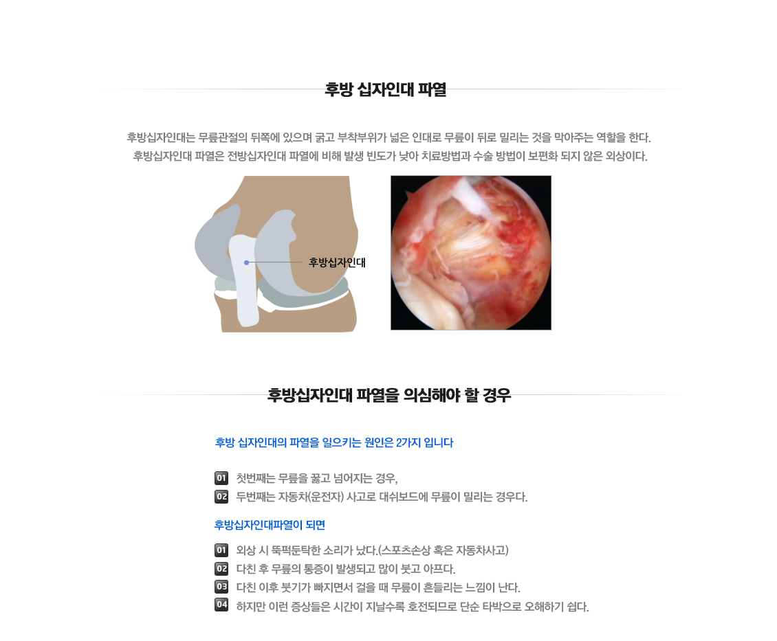 후방십자인대 파열