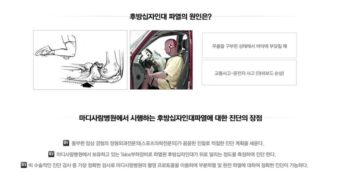 후방십자인대 파열