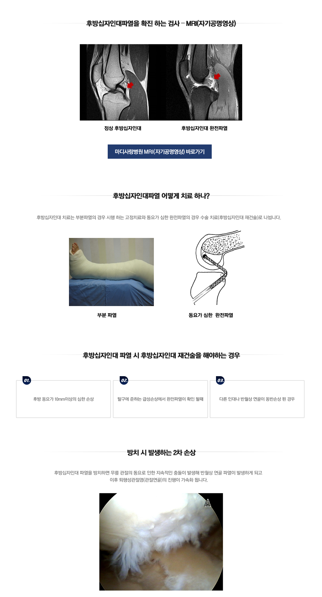 후방십자인대 파열