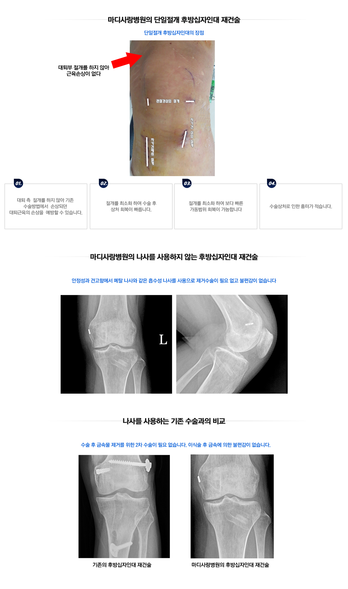 후방십자인대 파열