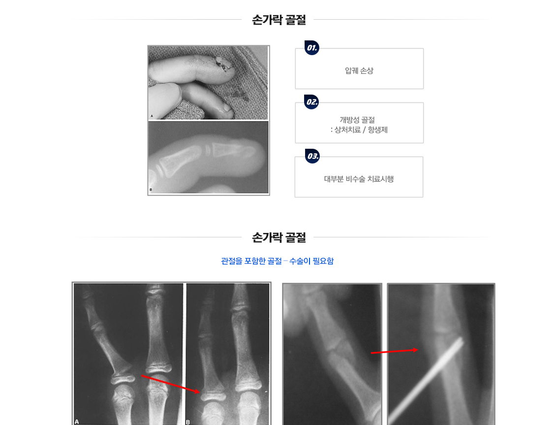 소아 골절