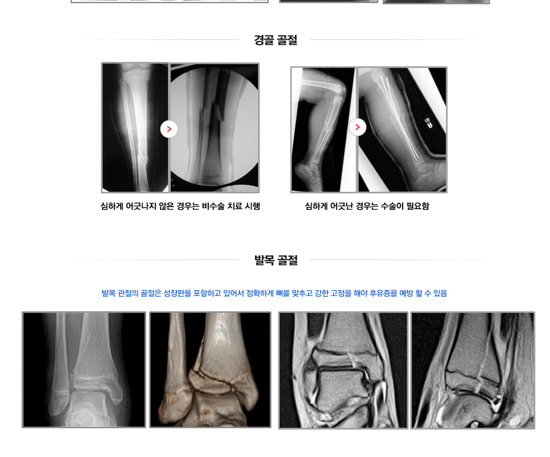 소아 골절