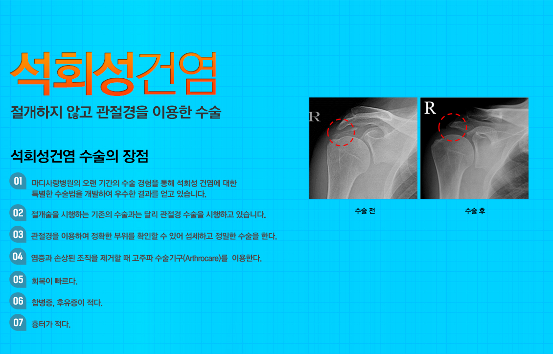 석회성건염