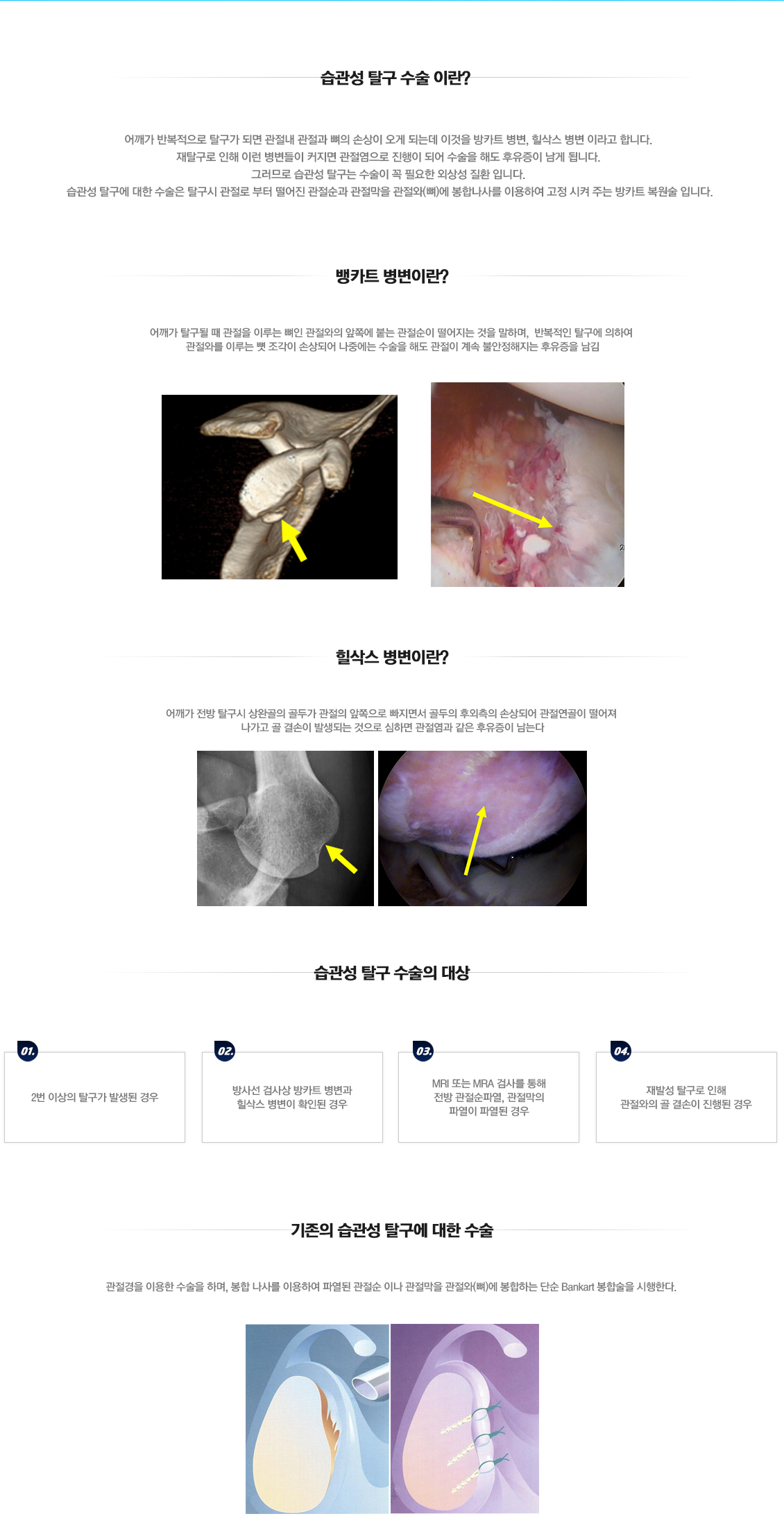 습관성 탈구