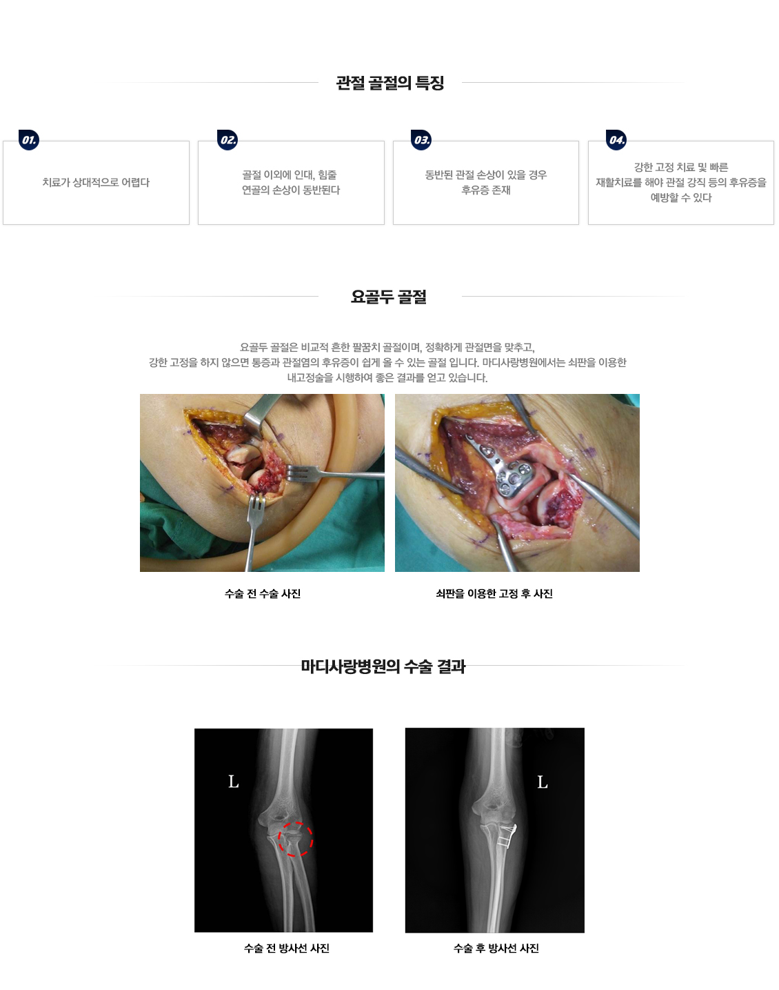 팔꿈치 골절수술 