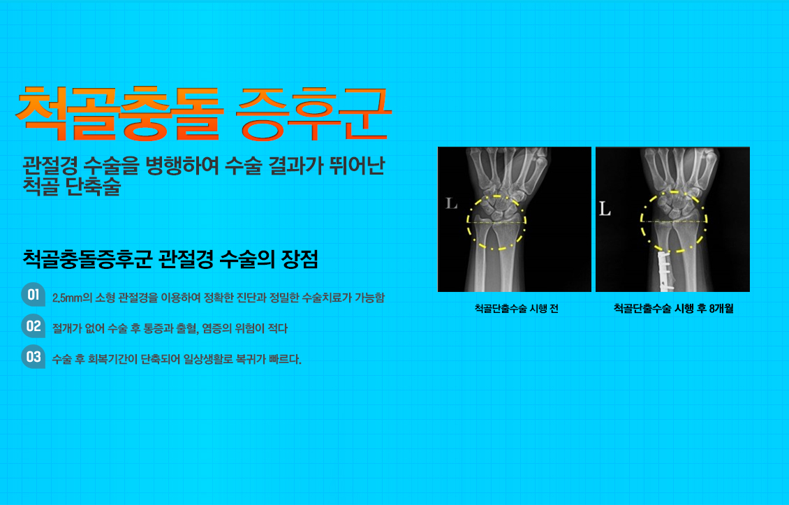 팔꿈치 골절수술