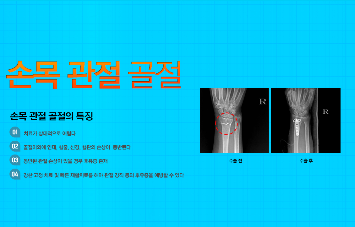 손목 골절수술