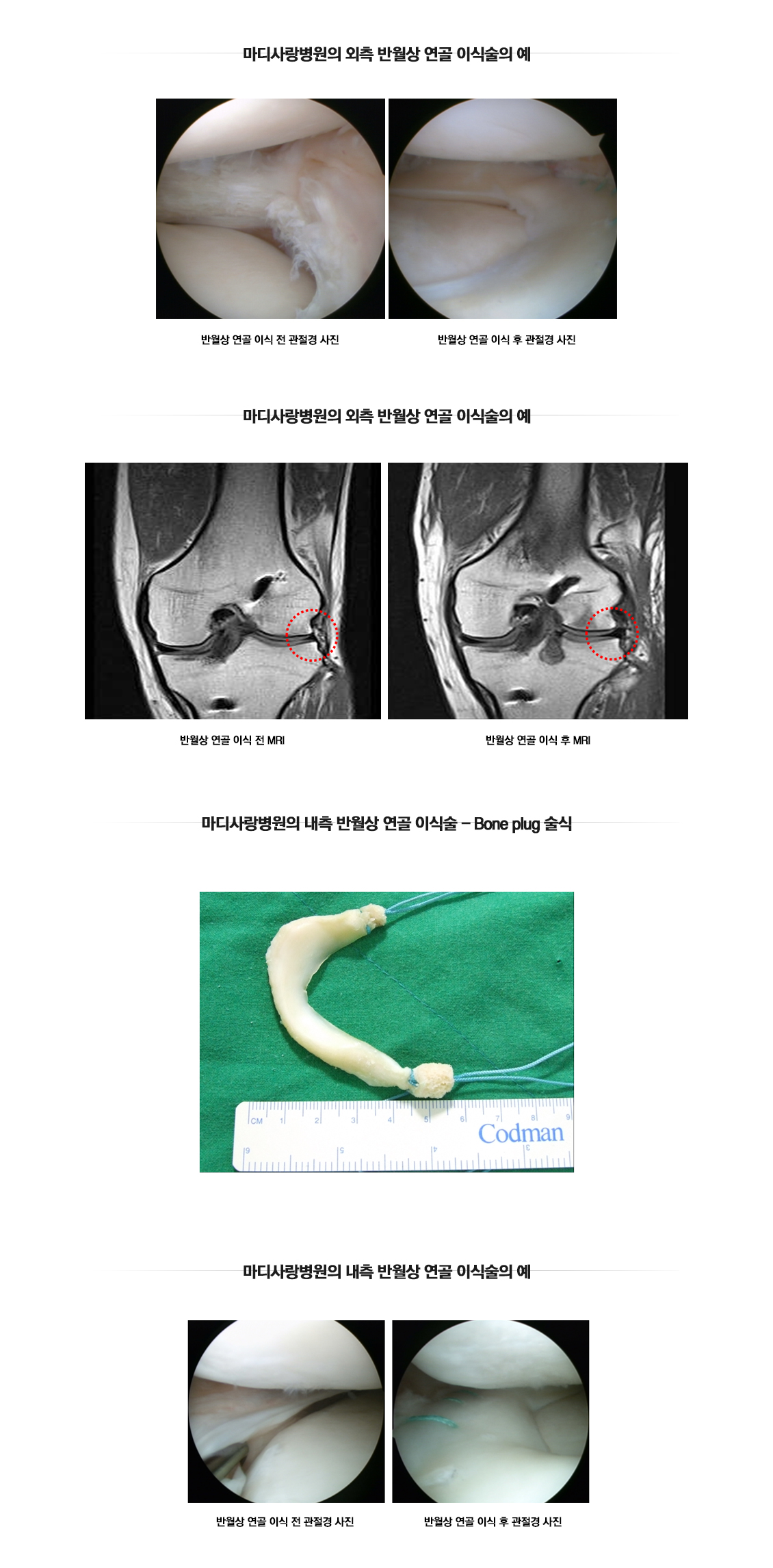 반월상연골 이식술