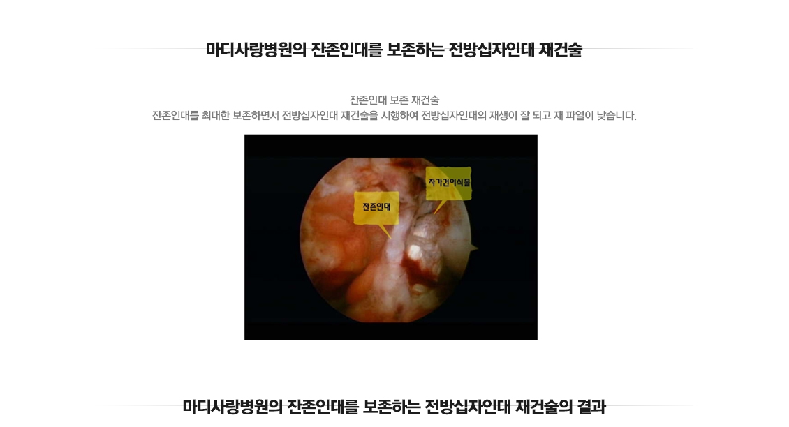 전방십자인대 재건술