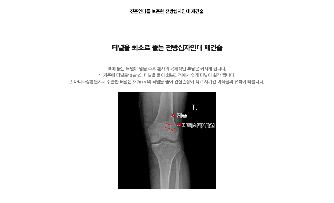 전방십자인대 재건술