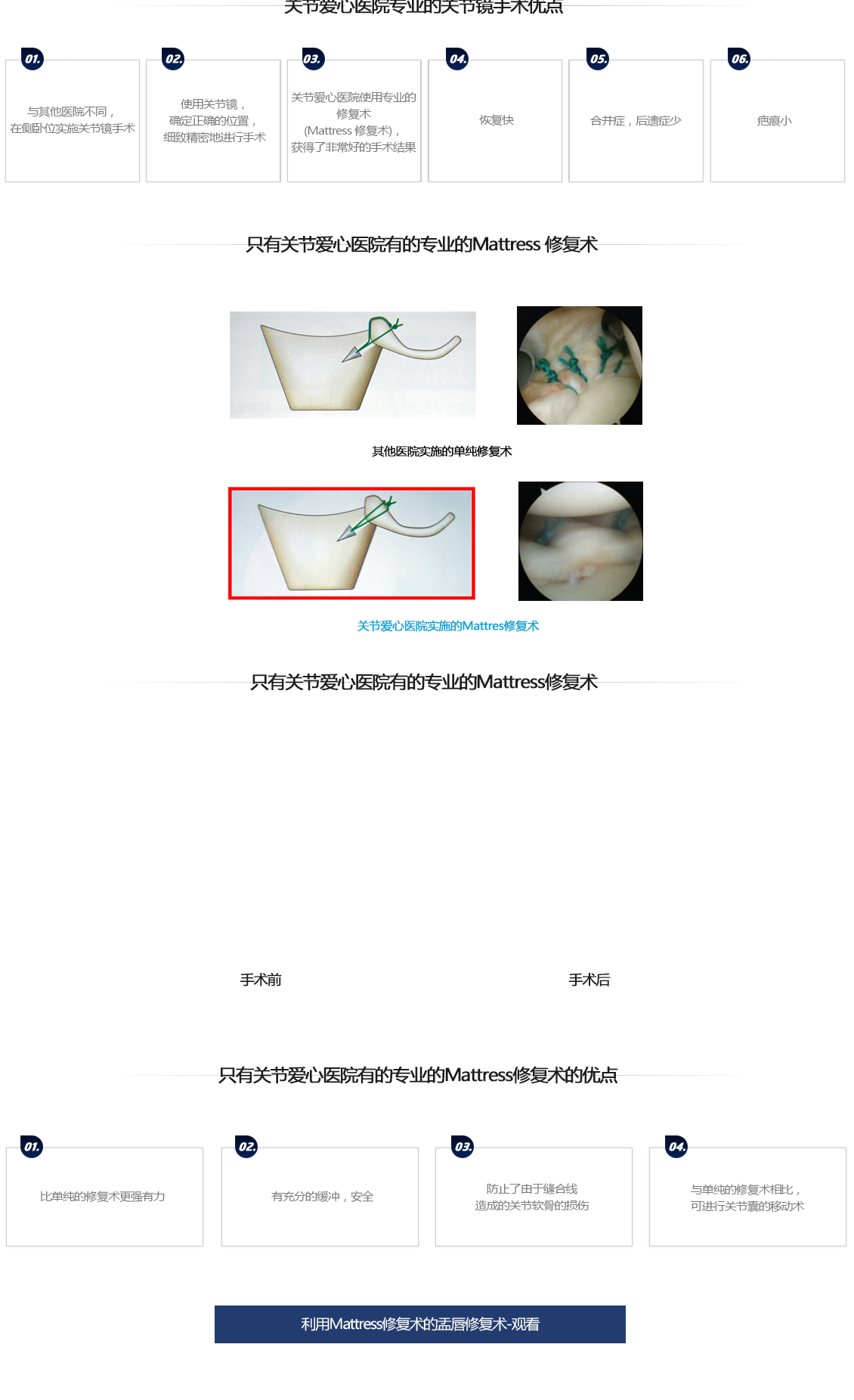 관절순파열