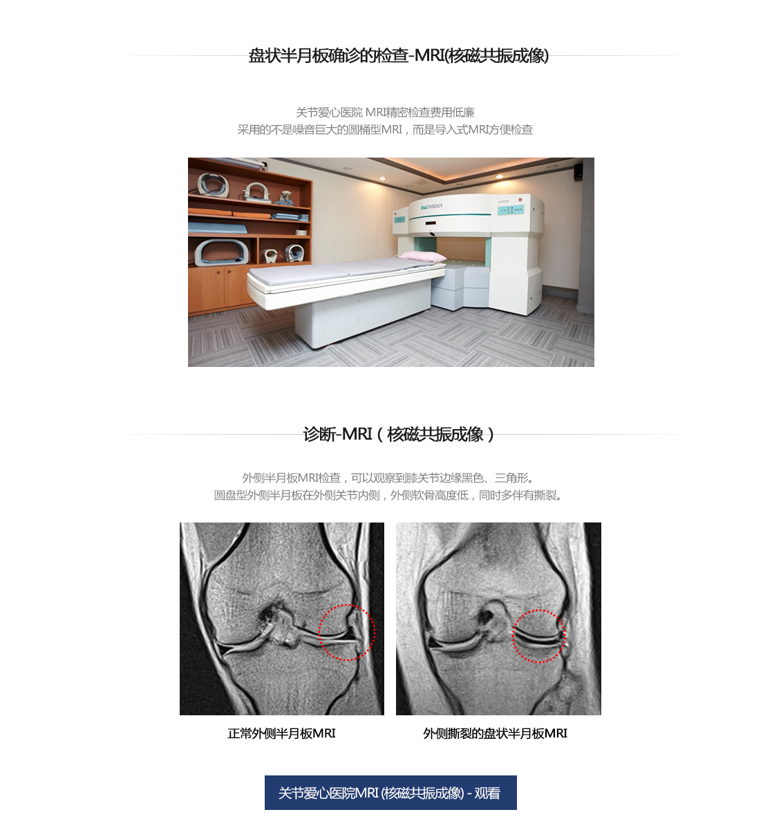 원판형 반월상 연골 파열