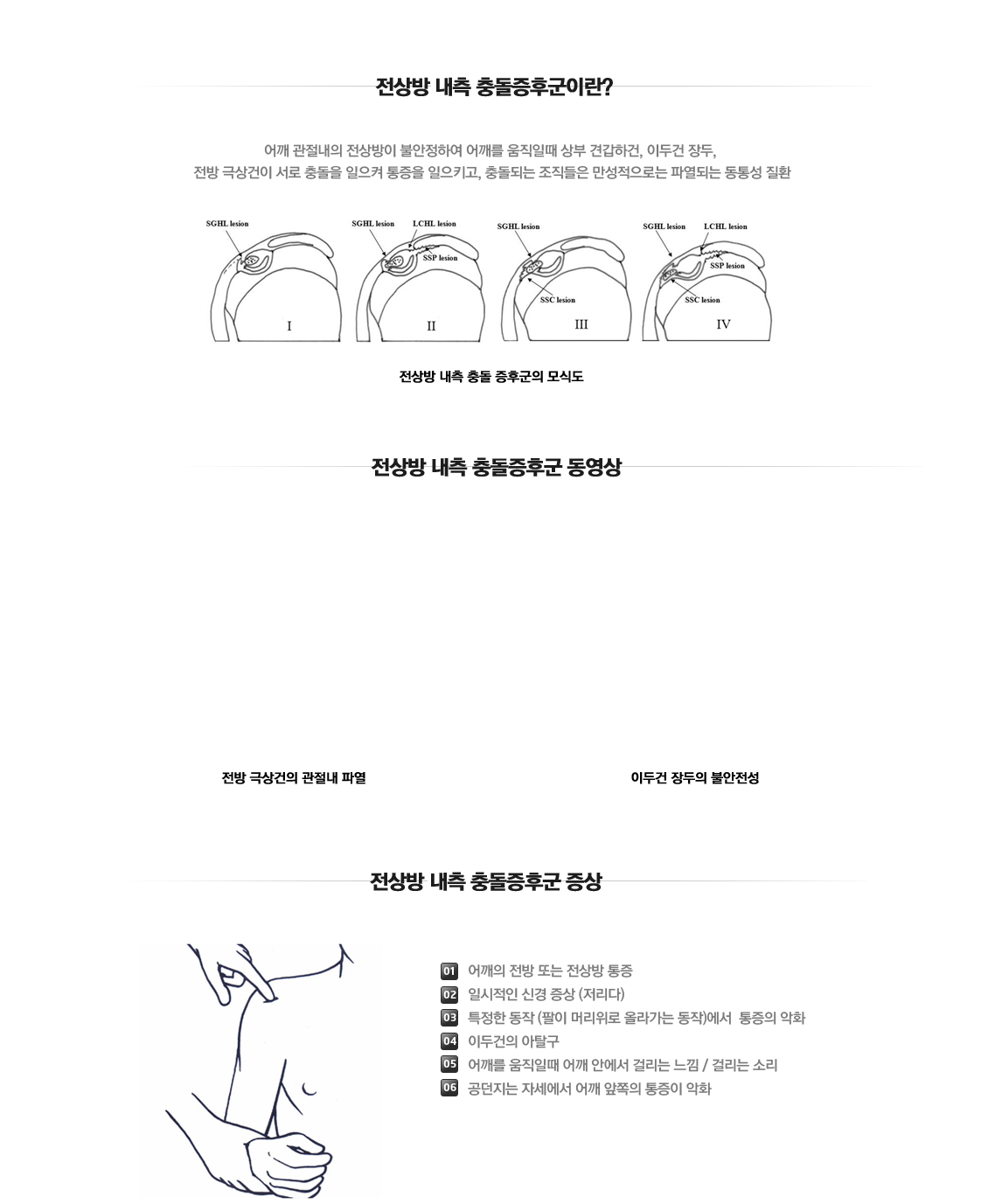 전상방내측Impingement syndrome 