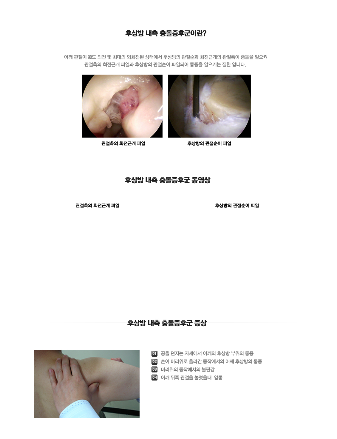 후상방내측Impingement syndrome 