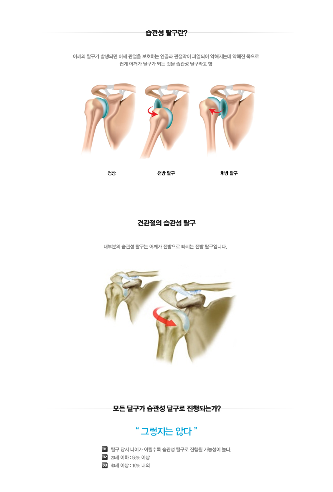 Recurrent dislocation