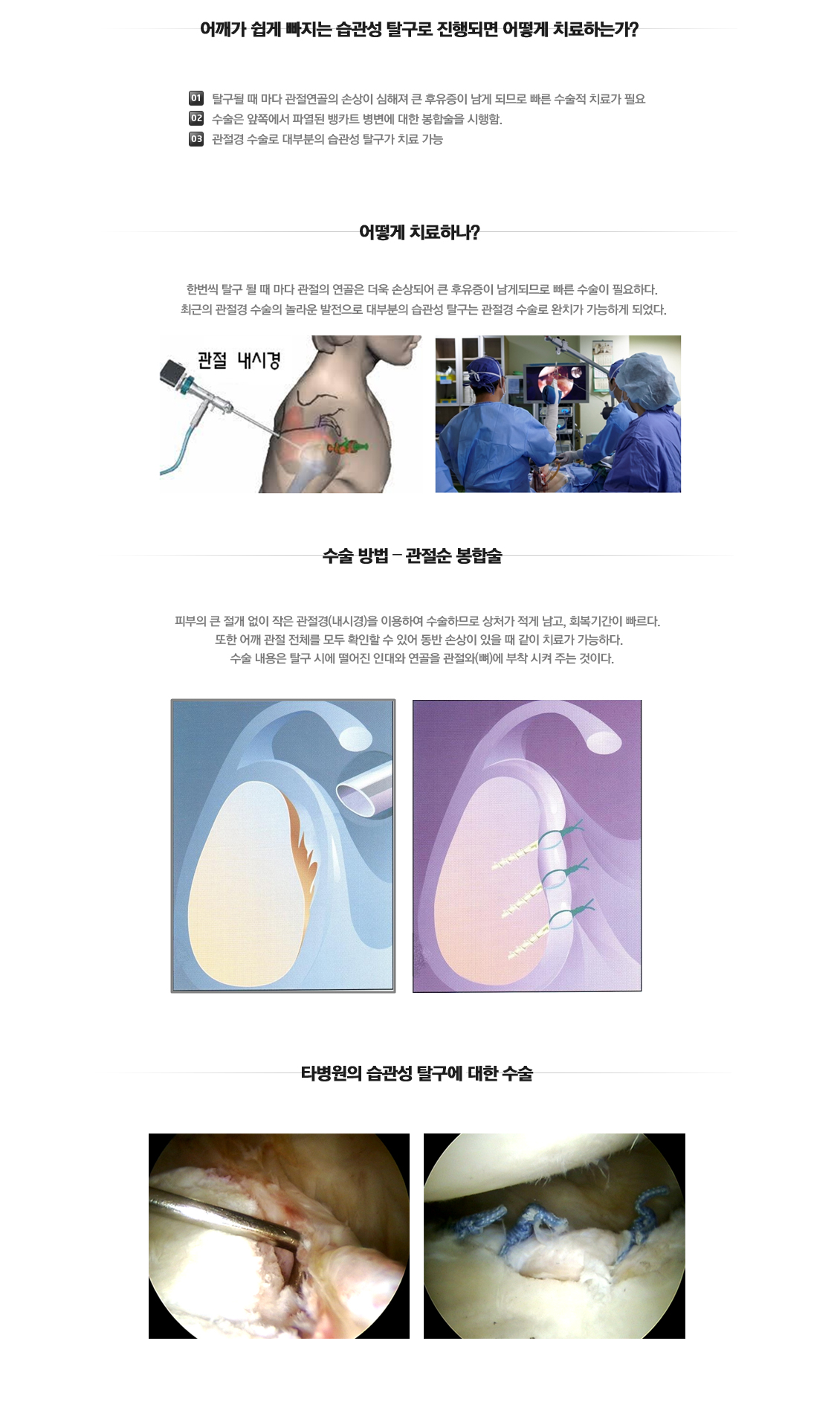 Recurrent dislocation