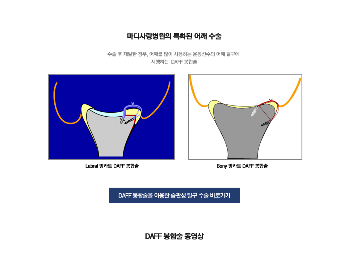 Recurrent dislocation