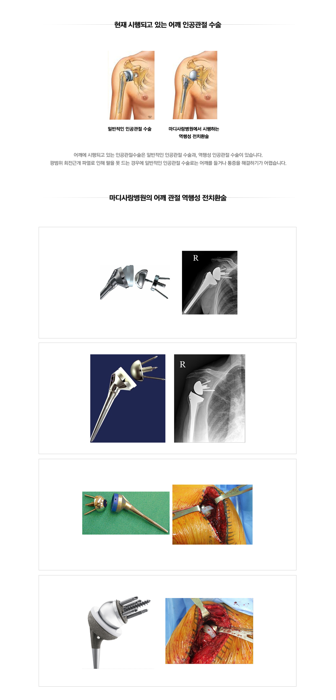 Impingement Syndrome