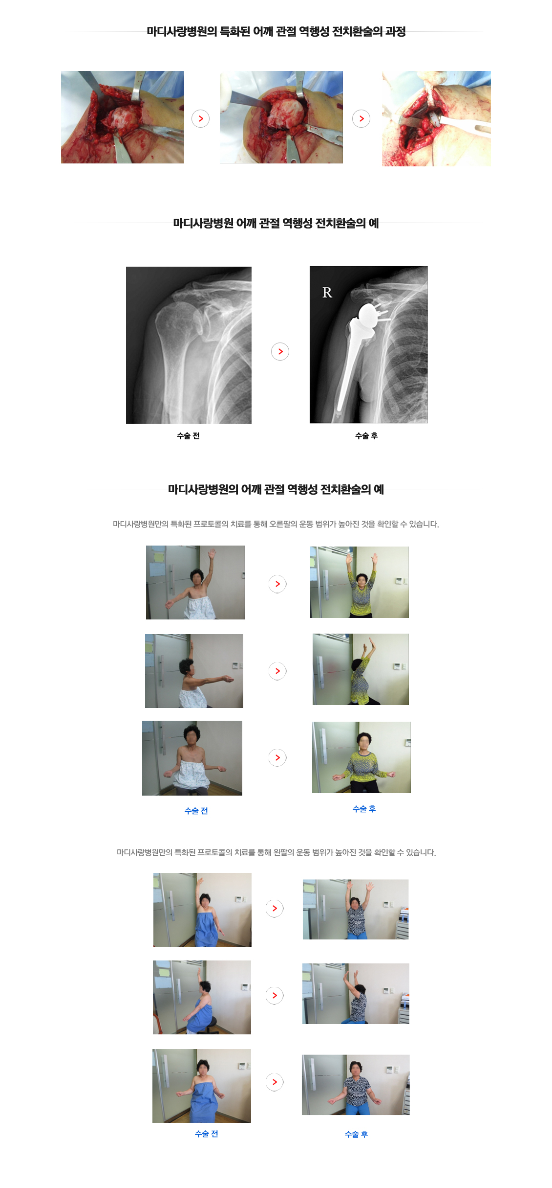 Impingement Syndrome
