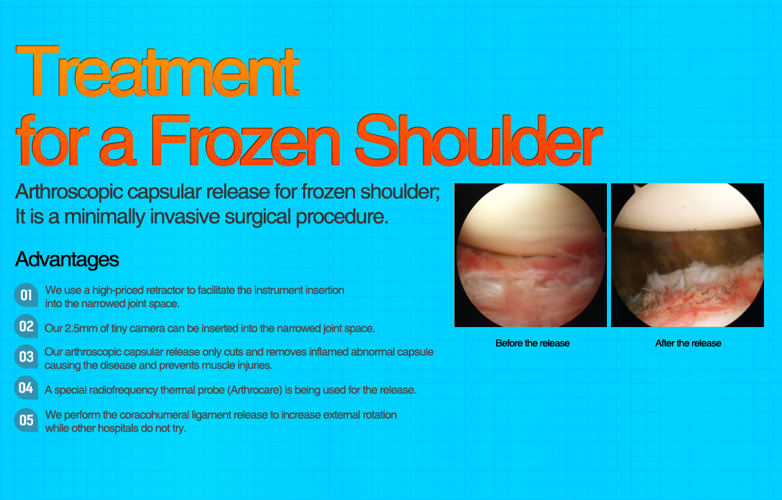 Frozen Shoulder