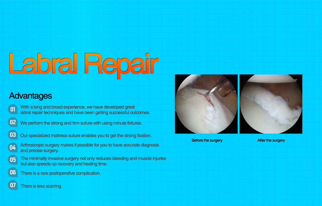 Distal Clavicle Excision