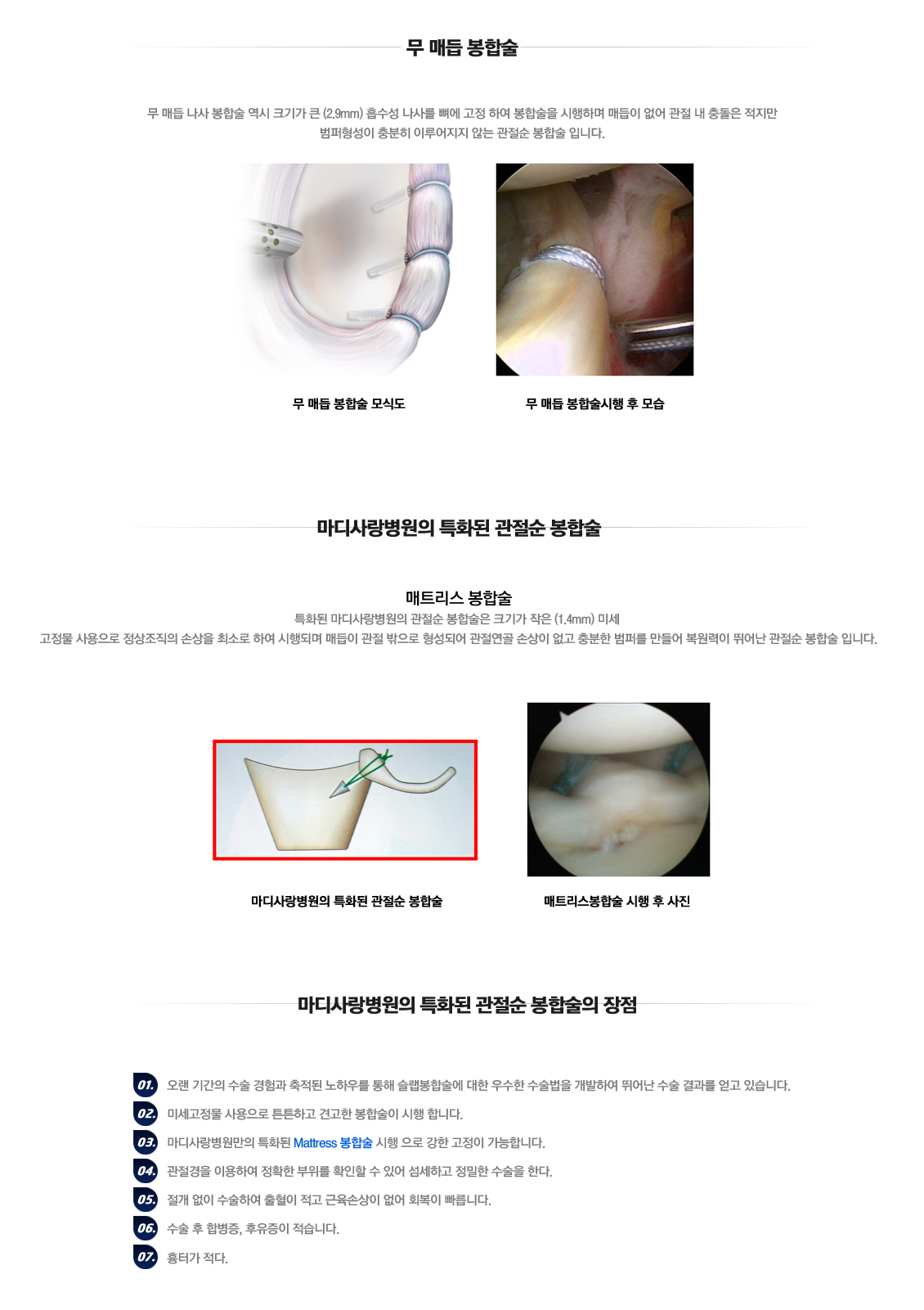 Distal Clavicle Excision