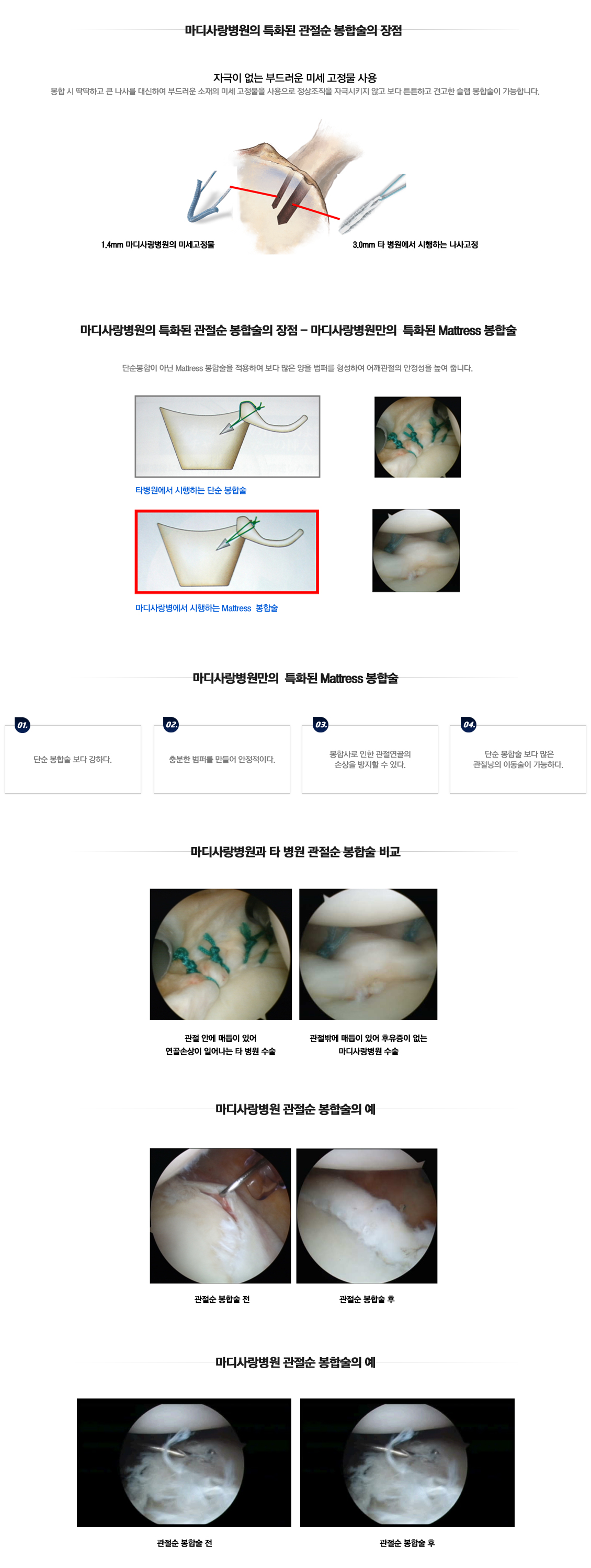 Distal Clavicle Excision