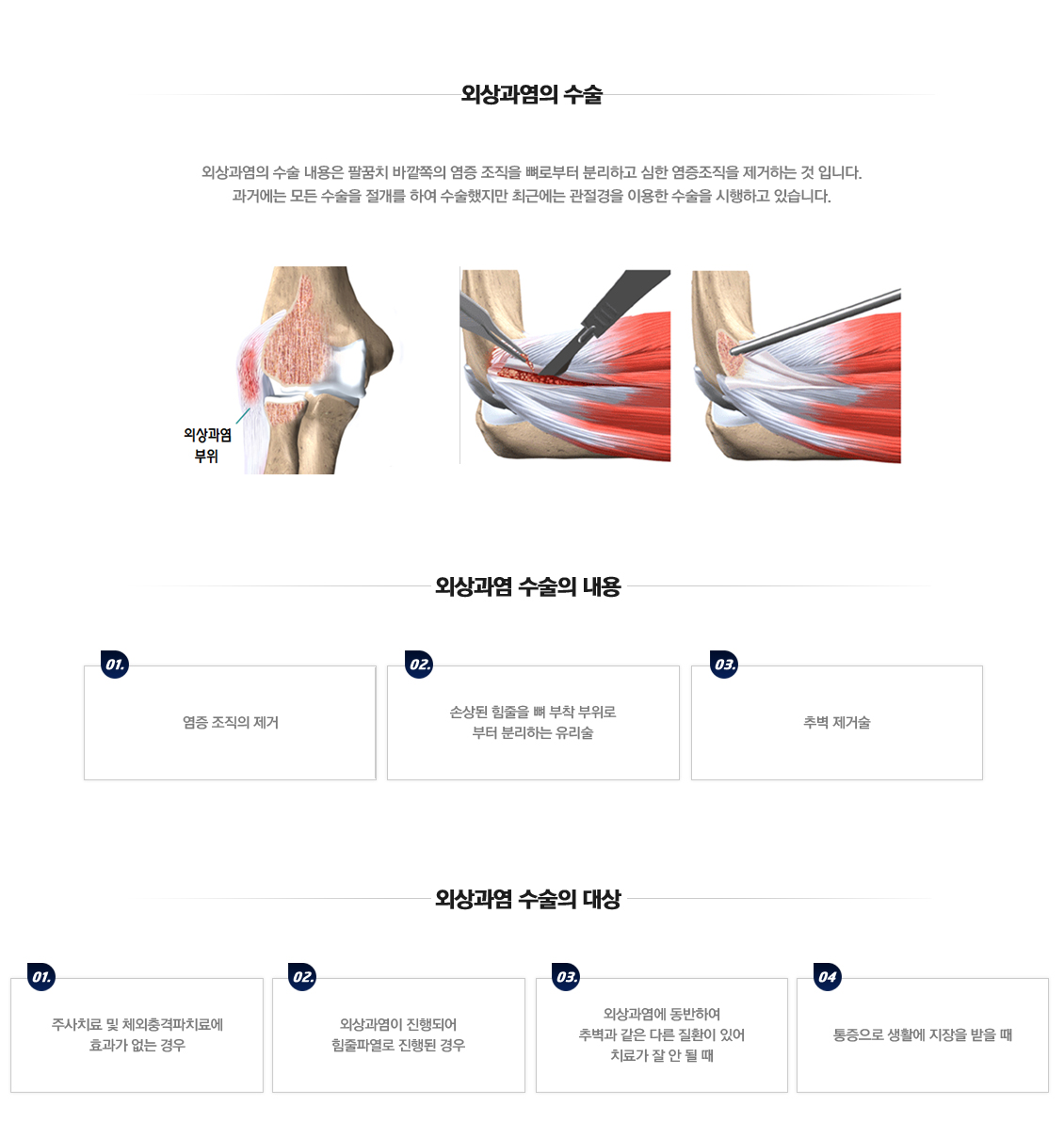 Lateral Epicondylitis 