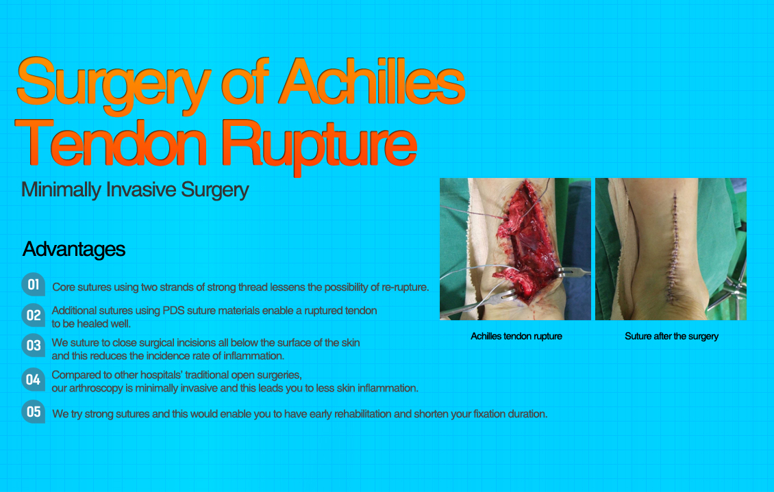 Lateral Ankle Instability Surgery