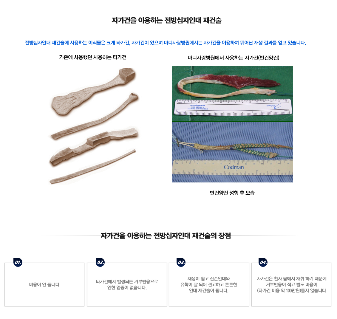 전방십자인대 파열