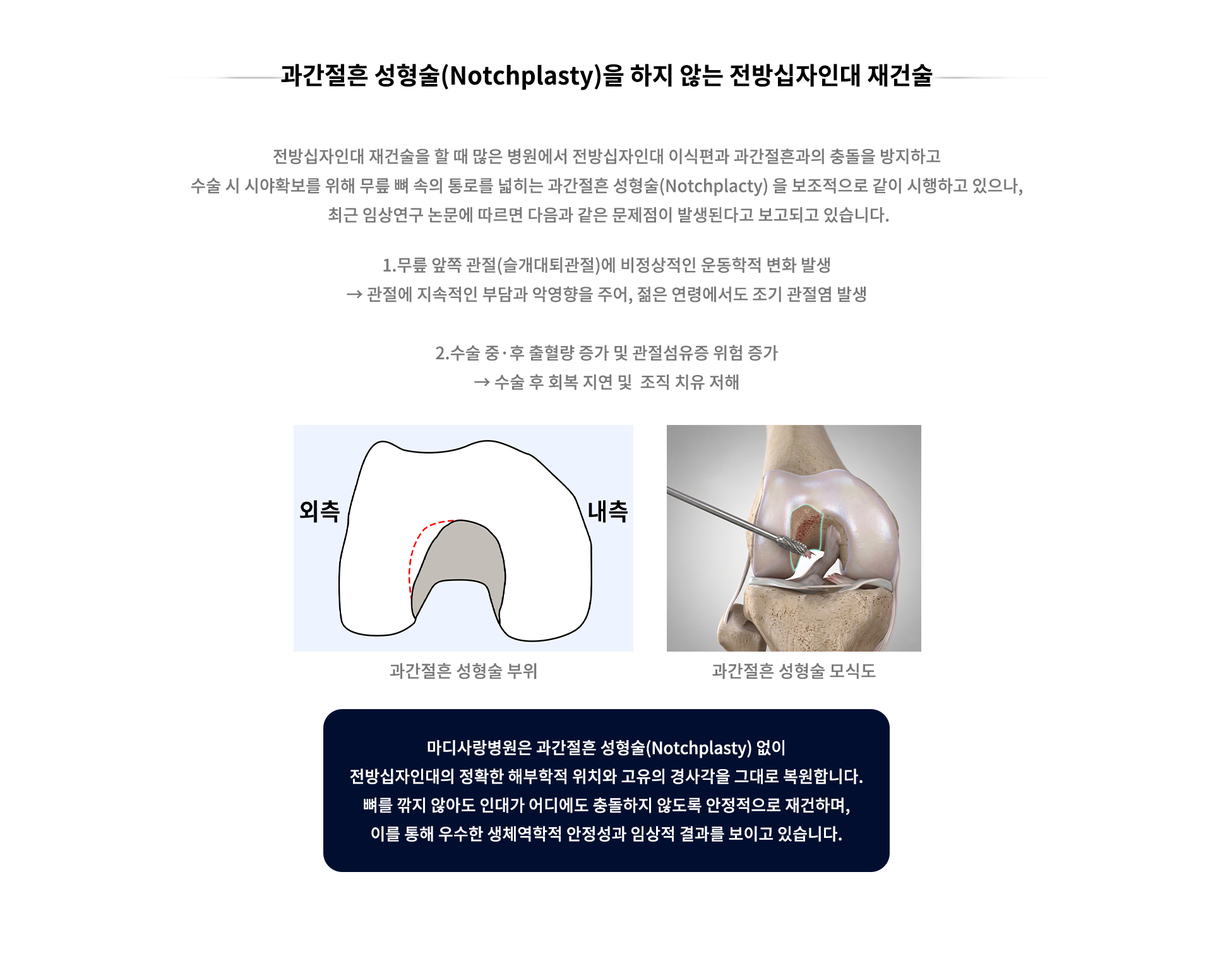 전방십자인대 파열