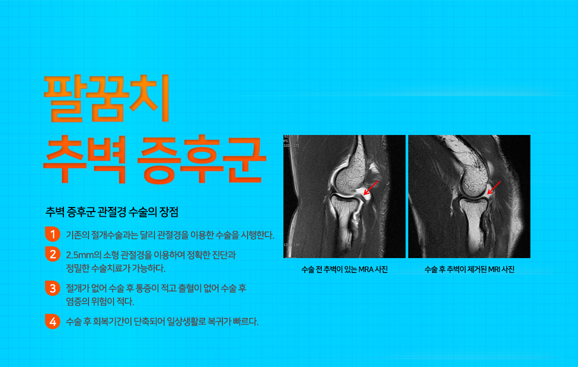 팔꿈치 추벽 증후군
