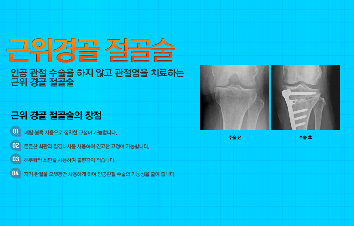 근위경골 절골술