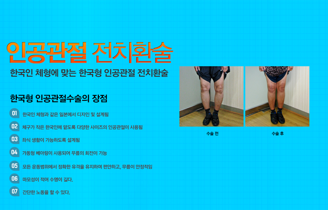 인공관절 전 치환술